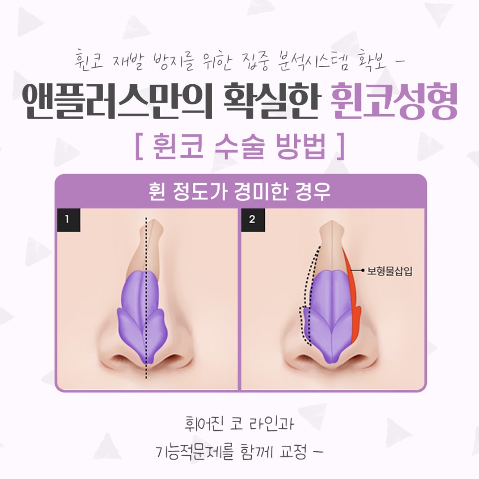 휜코성형후기 기능까지 확인해야 관련 이미지 9