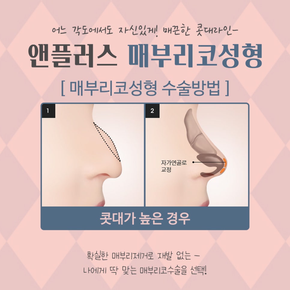 A Smooth Nasal Bridge Line Through Hump Nose Correction image 8