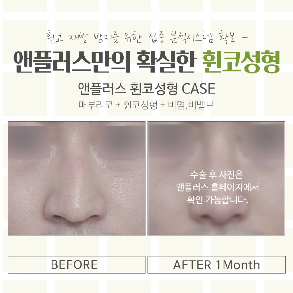 휜코수술에 대해 자세하게 확인하고 관련 이미지 13