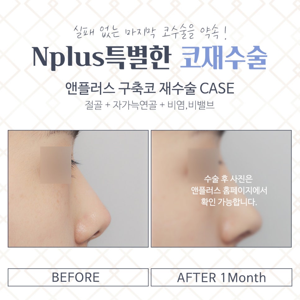 Properly Understanding Contracted Nose Revision Surgery image 14