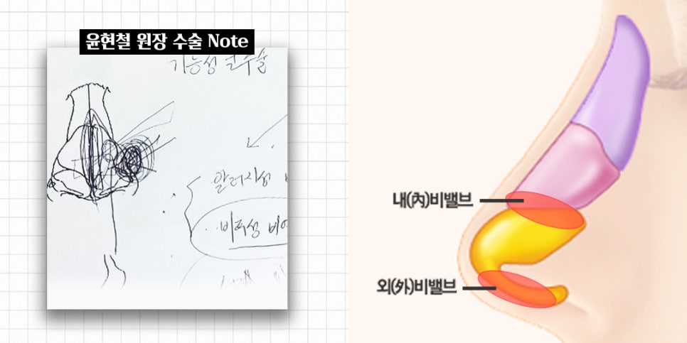 비염코성형에 대한 모든 것 완벽 정리 관련 이미지 9