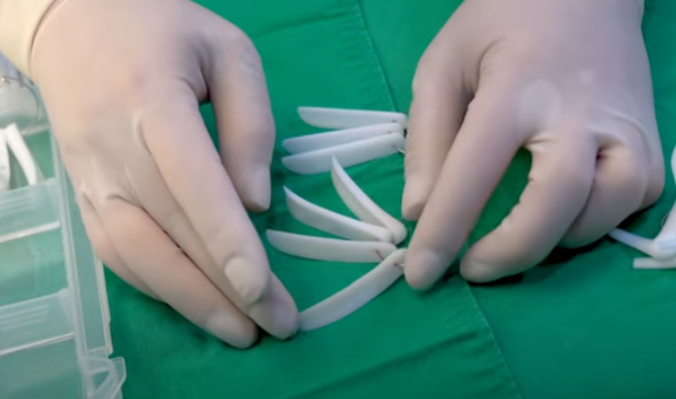 Check Whether a Non-Implant Rhinoplasty Is Possible in Your Case! image 2