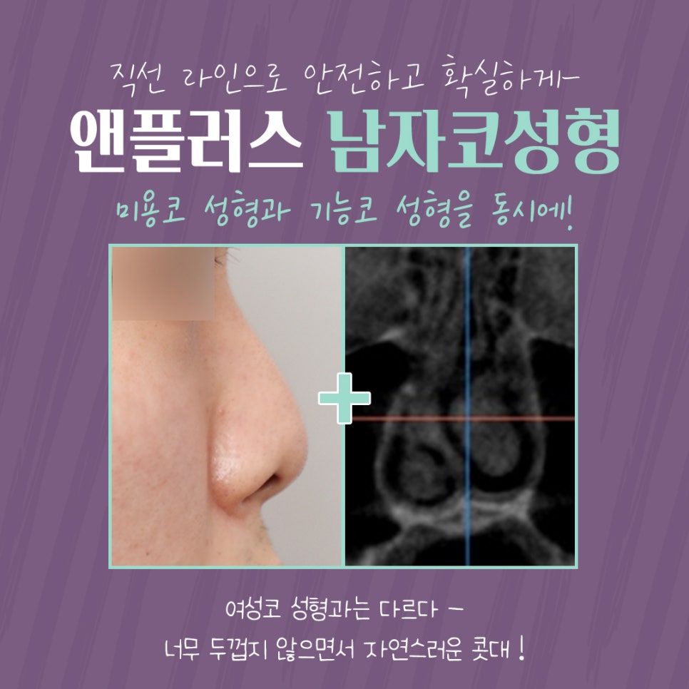 Male Nose Surgery Review, Including the Inside Examination image 5