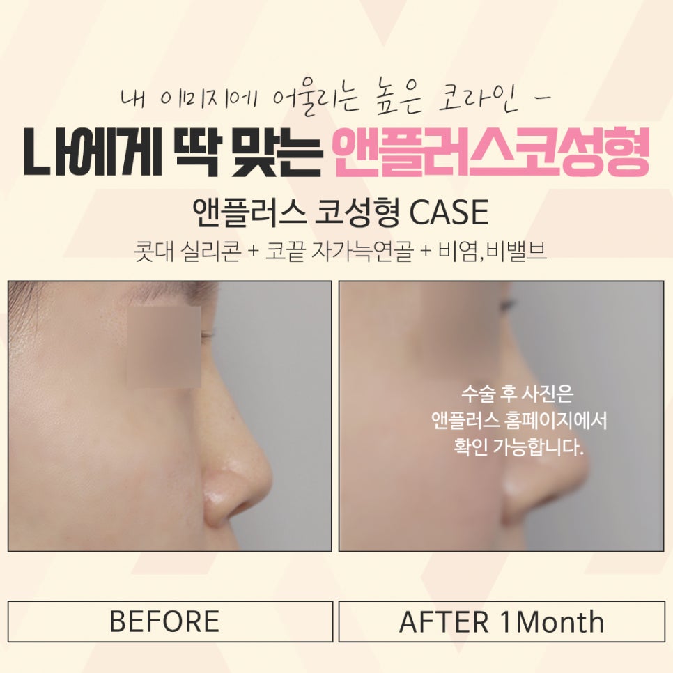 What to Carefully Consider Before and After Rhinoplasty image 13