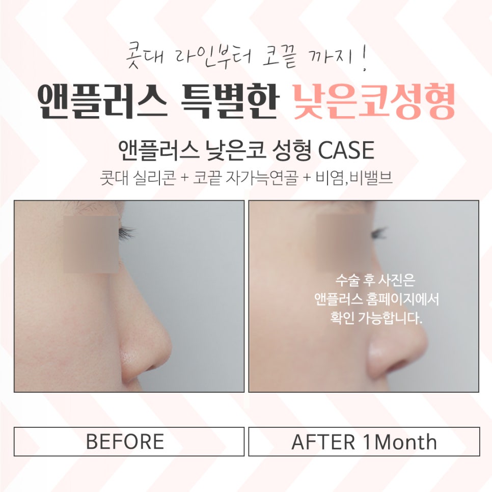 낮은코수술 여러 가지 사항을 고려하여 관련 이미지 12