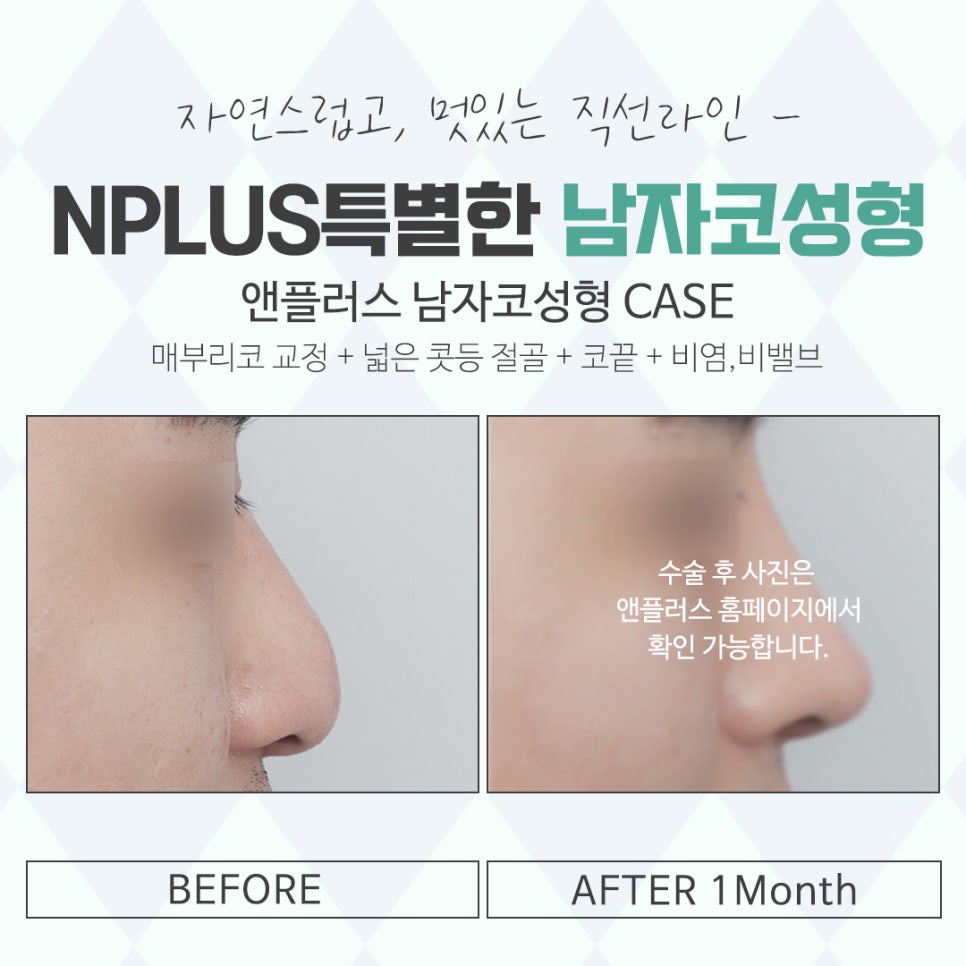 Check Male Rhinoplasty Before and After and Improve Your Image image 15