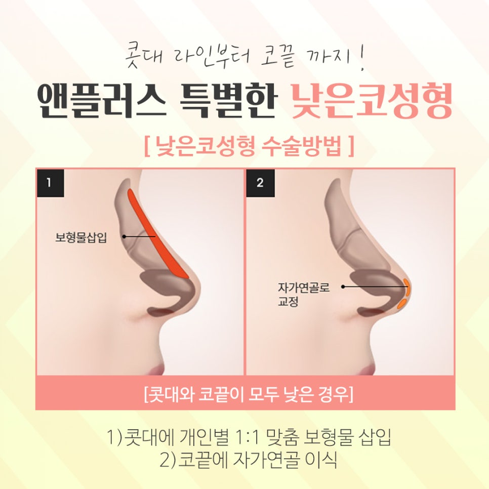 Creating a More Three-Dimensional Look with Low Nose Surgery image 7