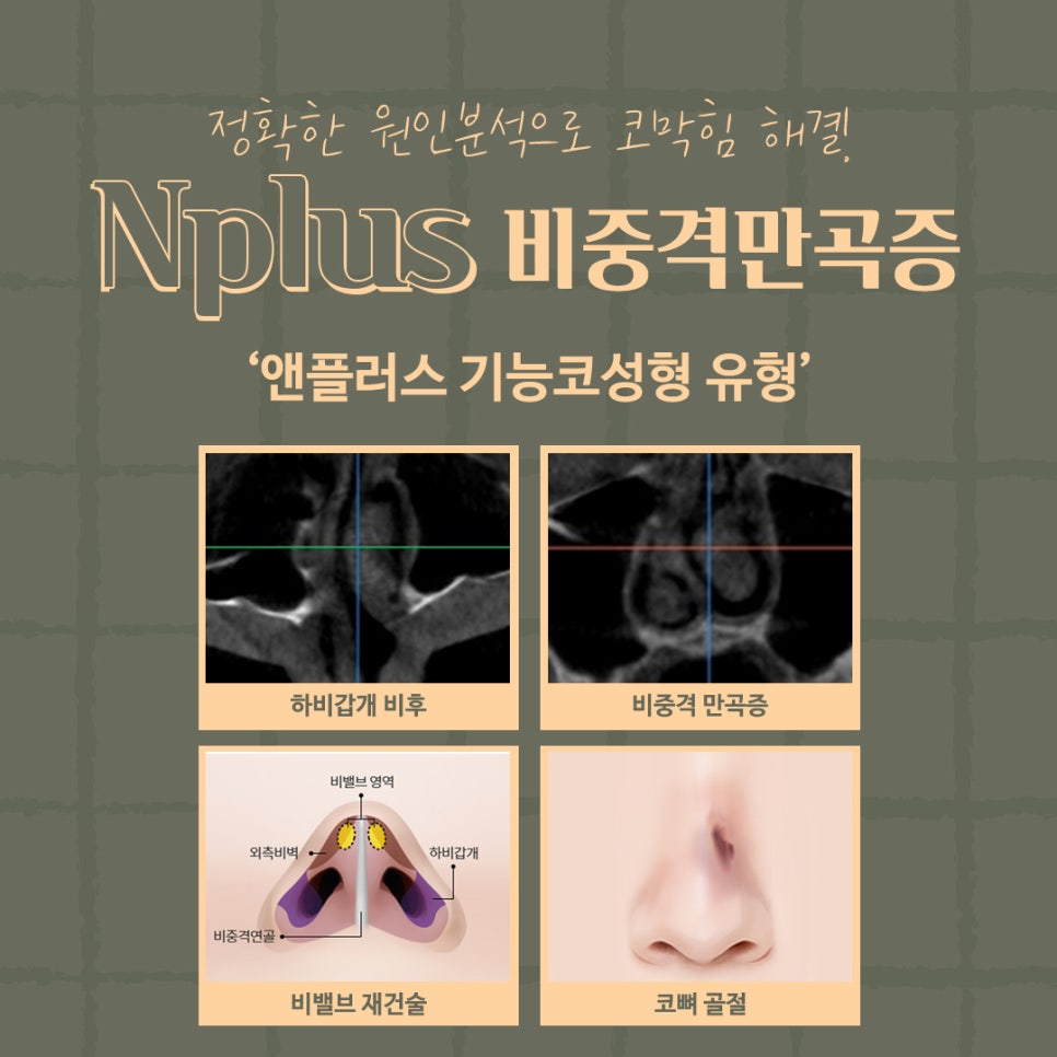 Septoplasty Surgery Explained at Gangnam Nose Surgery image 6