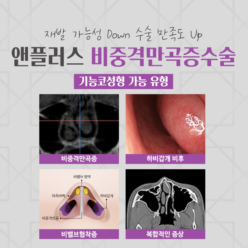 비중격만곡증수술 원인을 자세하게 관련 이미지 3