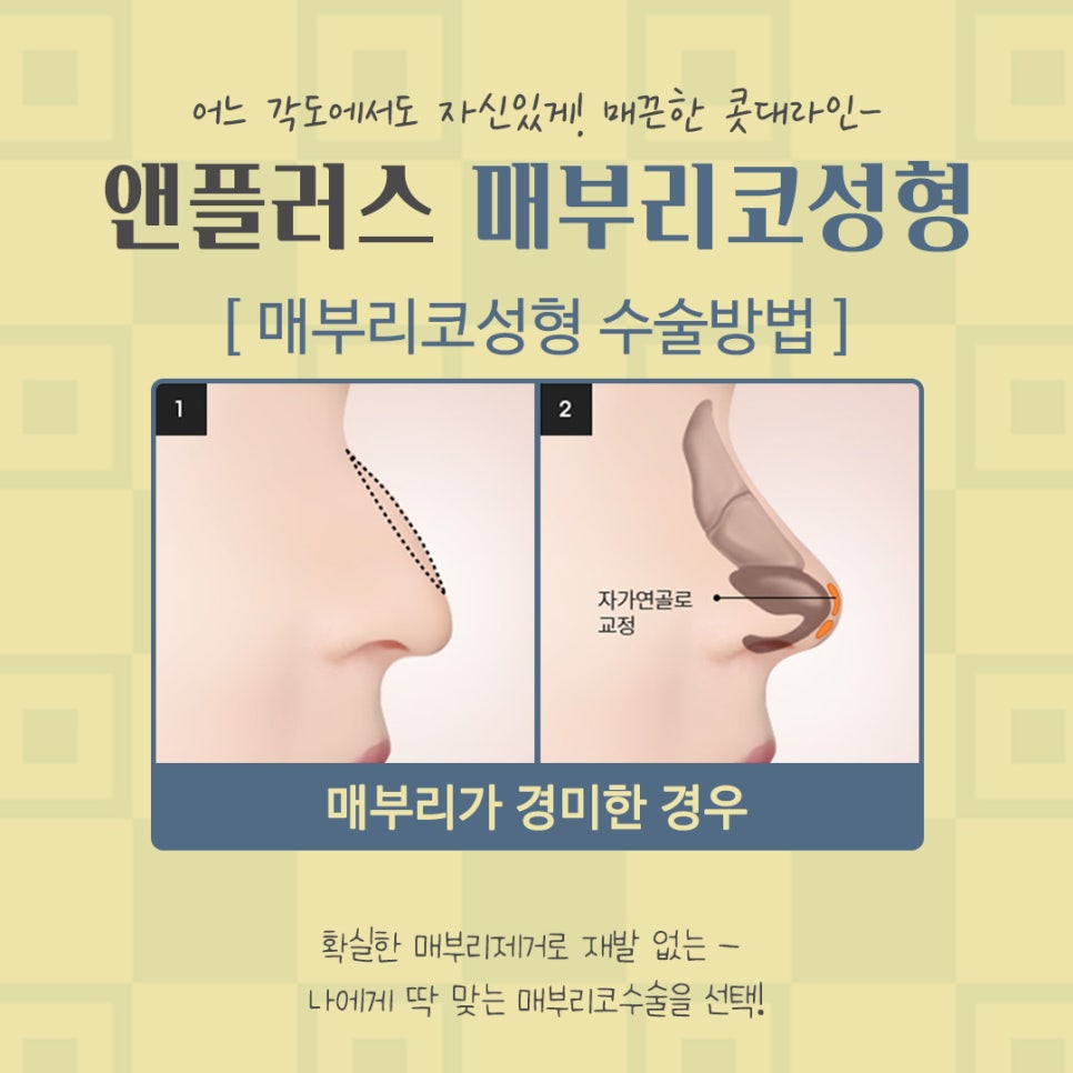 Nose Surgery Review for Correcting a Hump Nose image 11