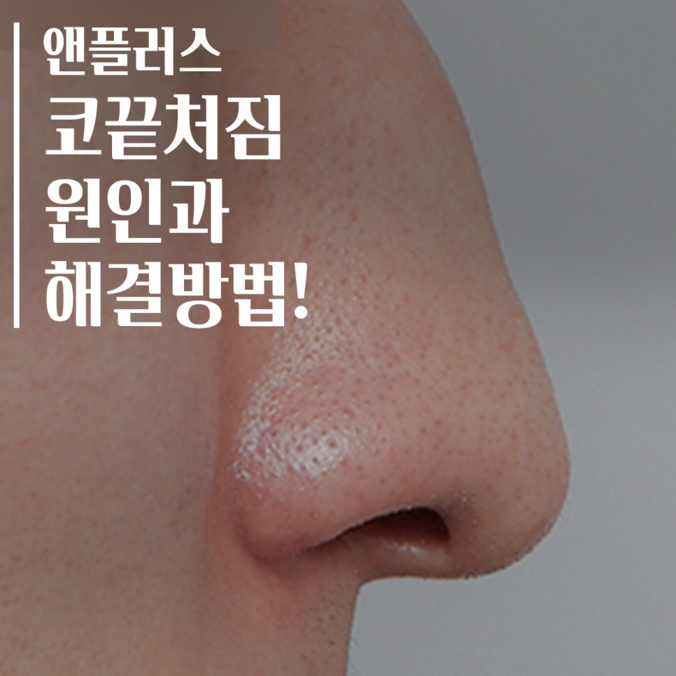 코성형 후 코끝처짐 원인과 해결 방법 관련 이미지 1