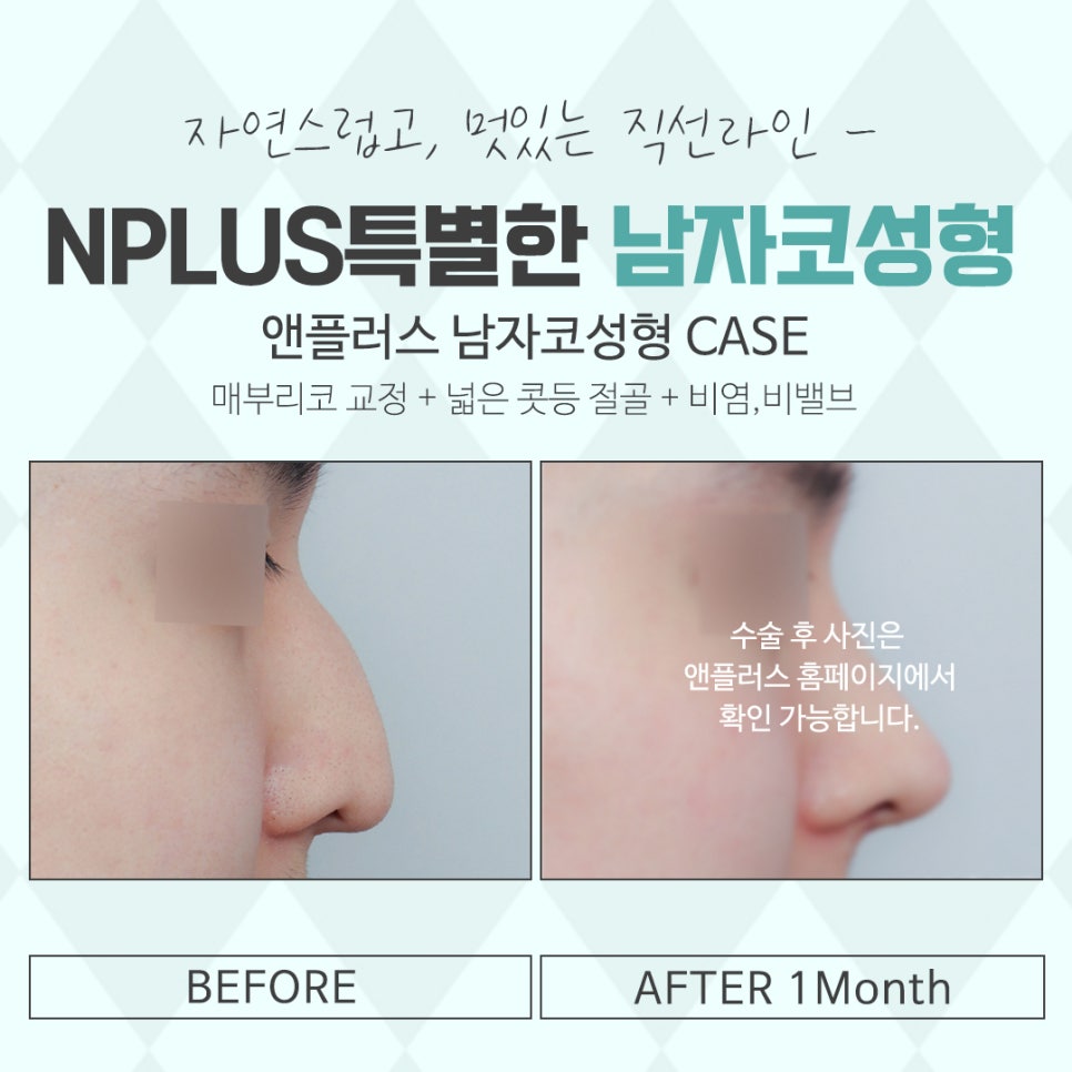 Looking into Male Rhinoplasty, Including Function image 14