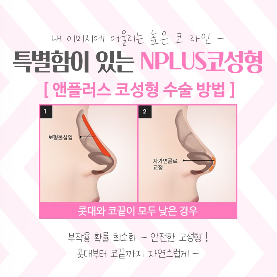 코성형잘하는곳 여러 가지를 고려하여 관련 이미지 8
