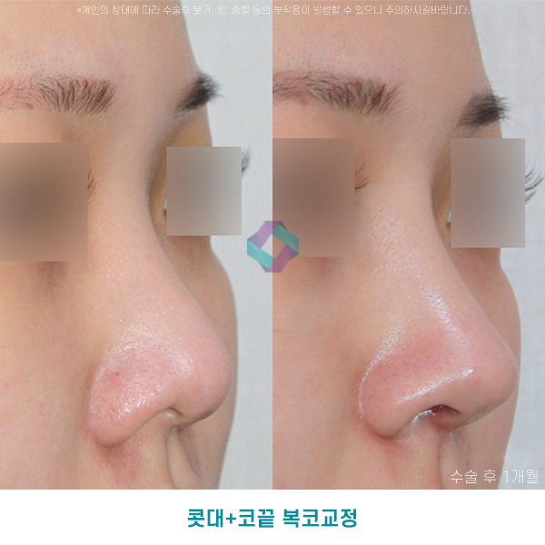 낮은코성형후기 참고하고 상담할때 관련 이미지 2