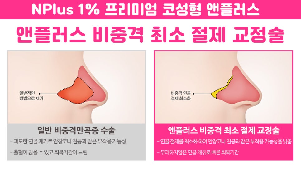 Septoplasty Surgery: A Careful Look From the Inside image 6