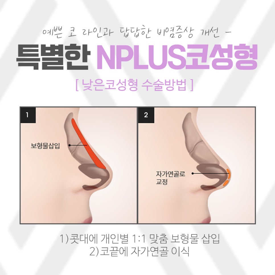 낮은코성형에 대한 정보를 찾아본다면 관련 이미지 7