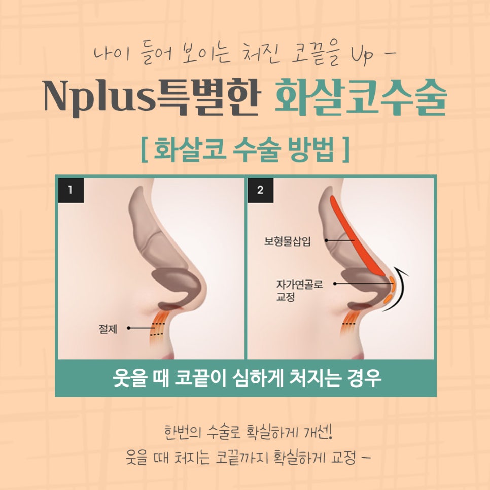 화살코수술 후기까지 알아보고 결정 관련 이미지 10