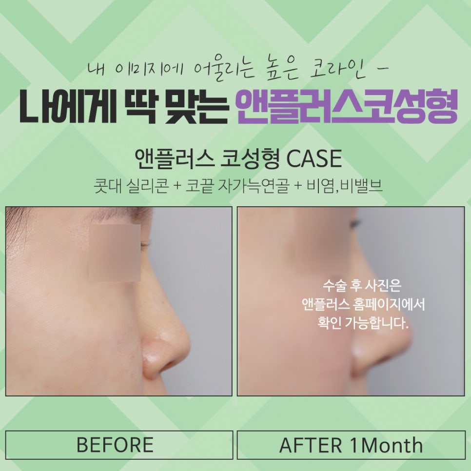 Check the Difference Before and After Rhinoplasty image 16