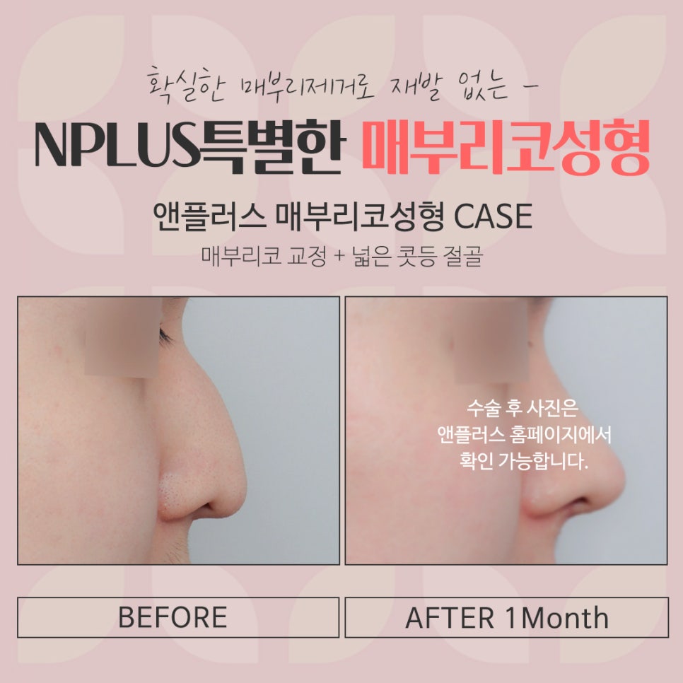 매부리코수술후기 자세하게 알아봐야 관련 이미지 16