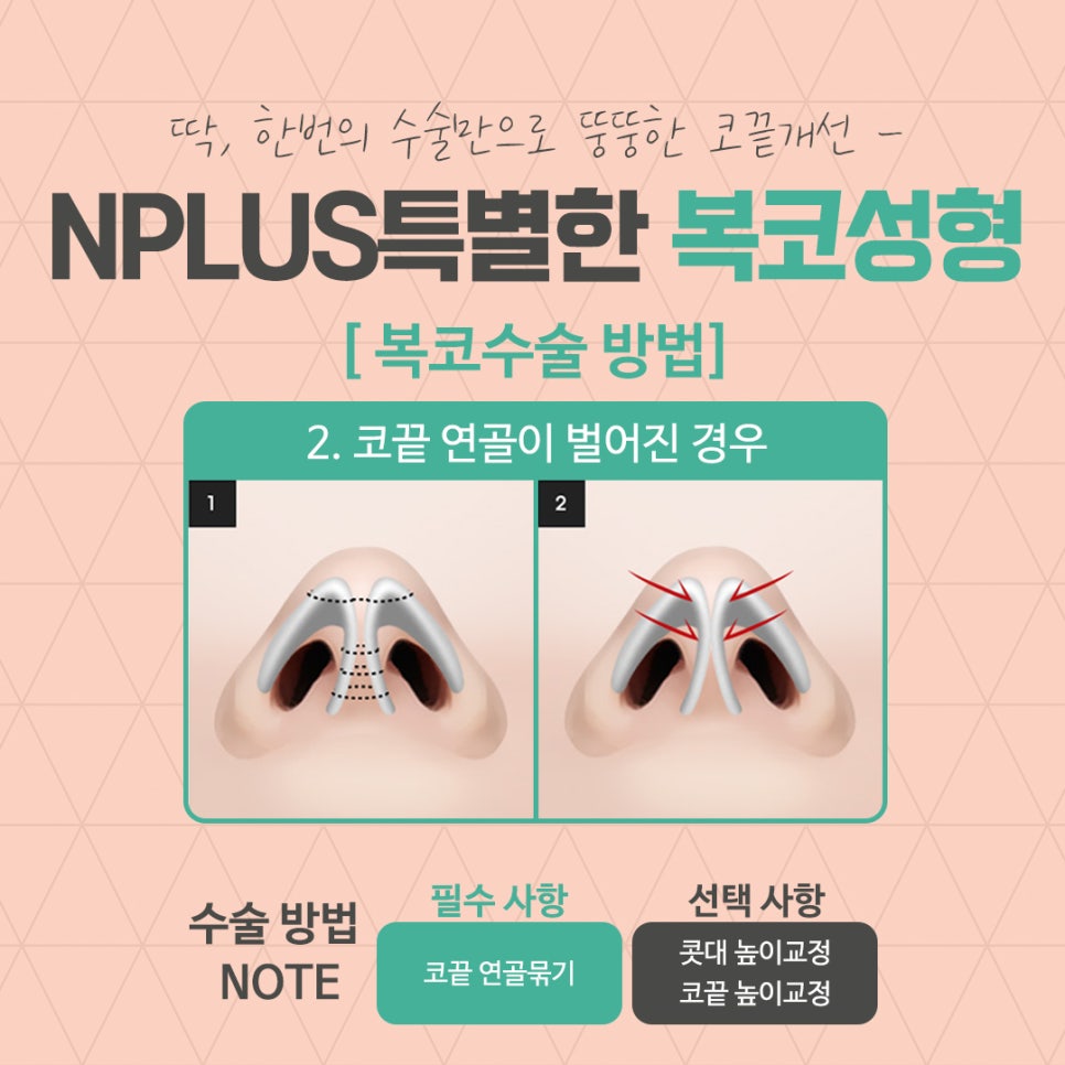 복코성형후기 코지방제거로 확실하게 관련 이미지 8