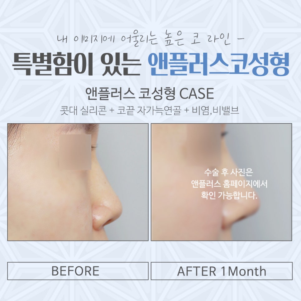 Carefully Reviewing Rhinoplasty Costs image 13