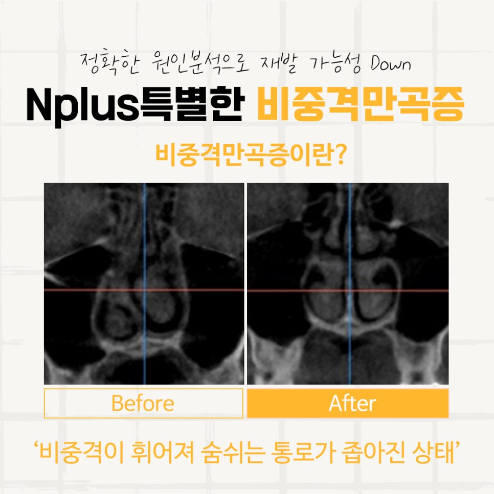Septoplasty Surgery Review: With a Careful Decision image 6