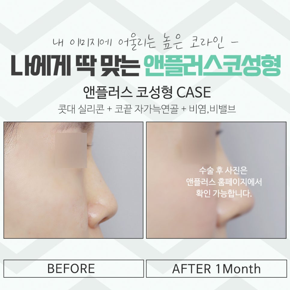 코성형후기 자연스러운 코라인으로 관련 이미지 16