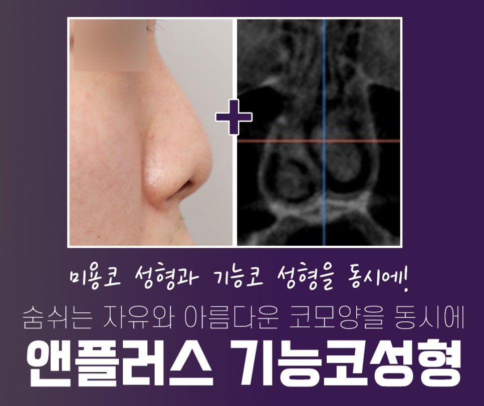 앤플러스에서 알려드리는 성형외과 기능코성형후기 관련 이미지 2