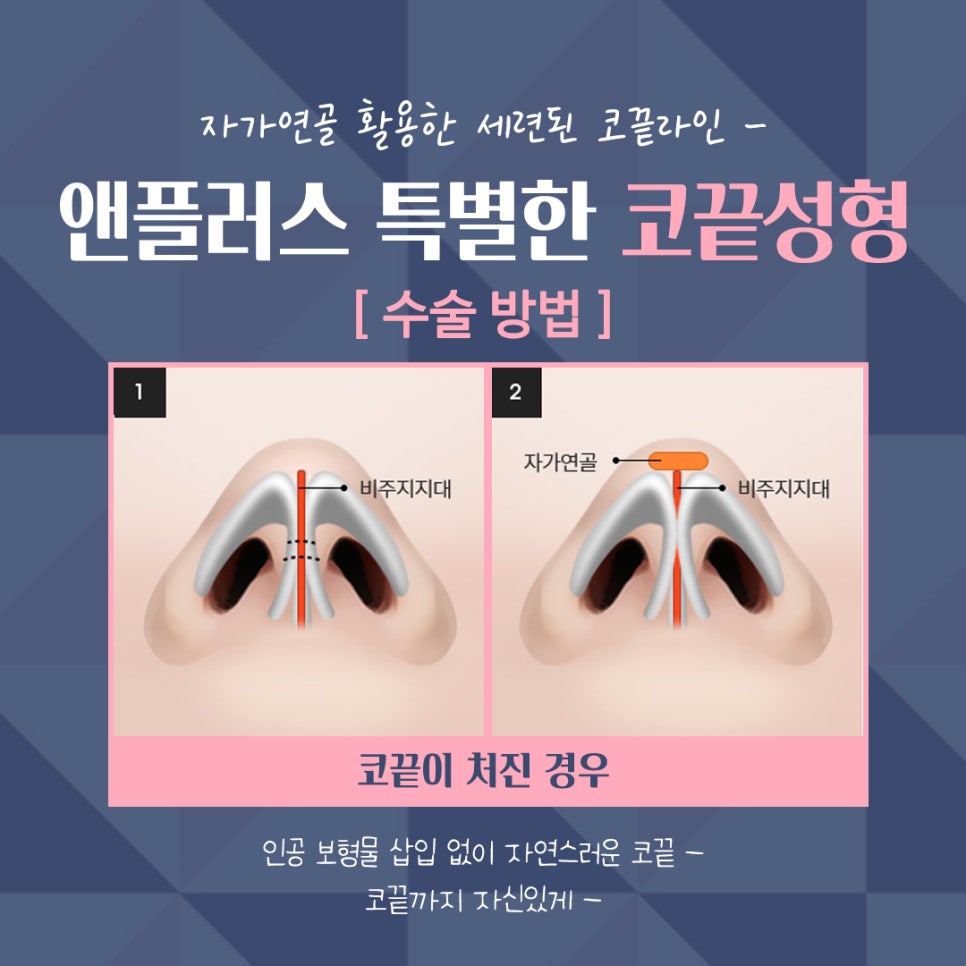 Nose Tip Surgery Review Using Tip Cartilage Suturing image 11