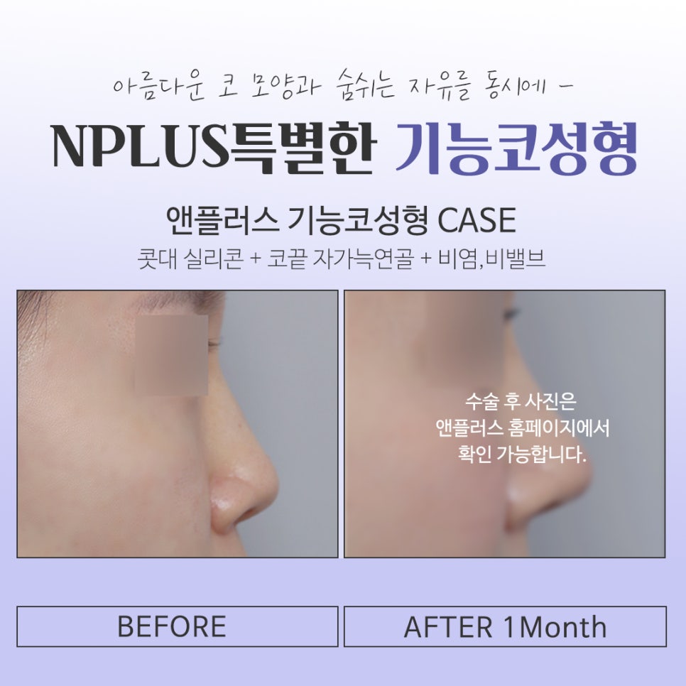 Check the Difference in Functional Nose Surgery Reviews image 15