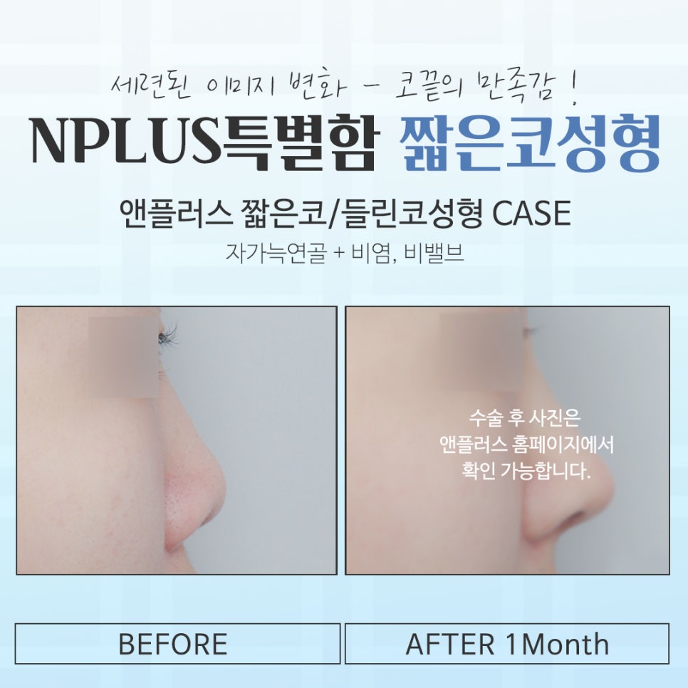 Short Nose Surgery for a Harmonious Line image 14