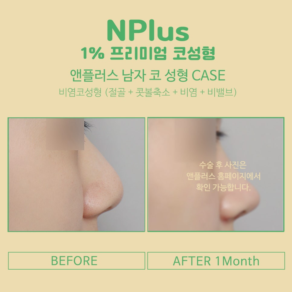 비염수술코성형 동시에 개선이 가능 관련 이미지 9