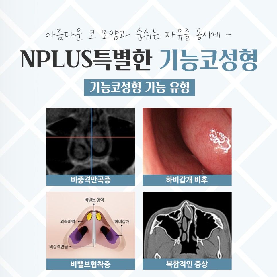 기능코성형후기를 통해 개선된 점 관련 이미지 5