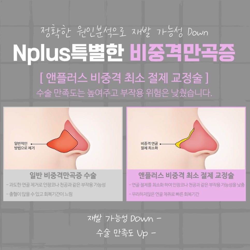 비중격만곡증수술 후기를 알아보고 결정 관련 이미지 12