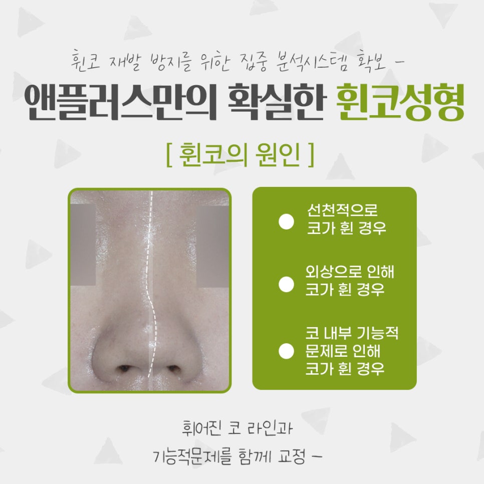 Whistling Nose Surgery Review: A Natural and Beautiful Line image 4