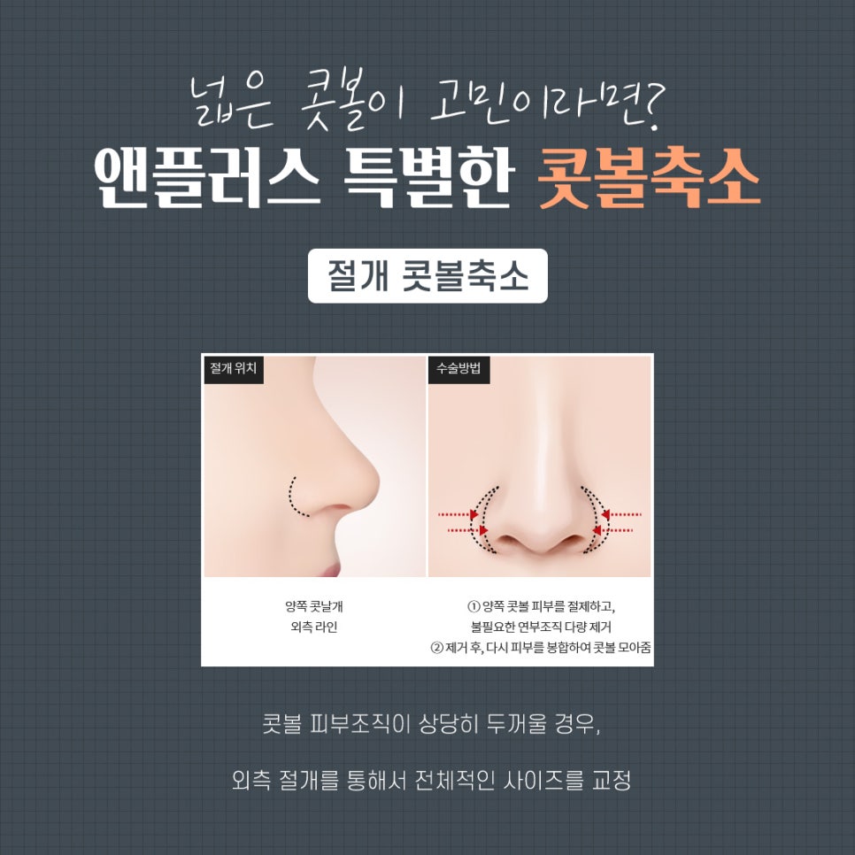 콧볼축소수술 흉터 없이 자연스럽게 관련 이미지 7