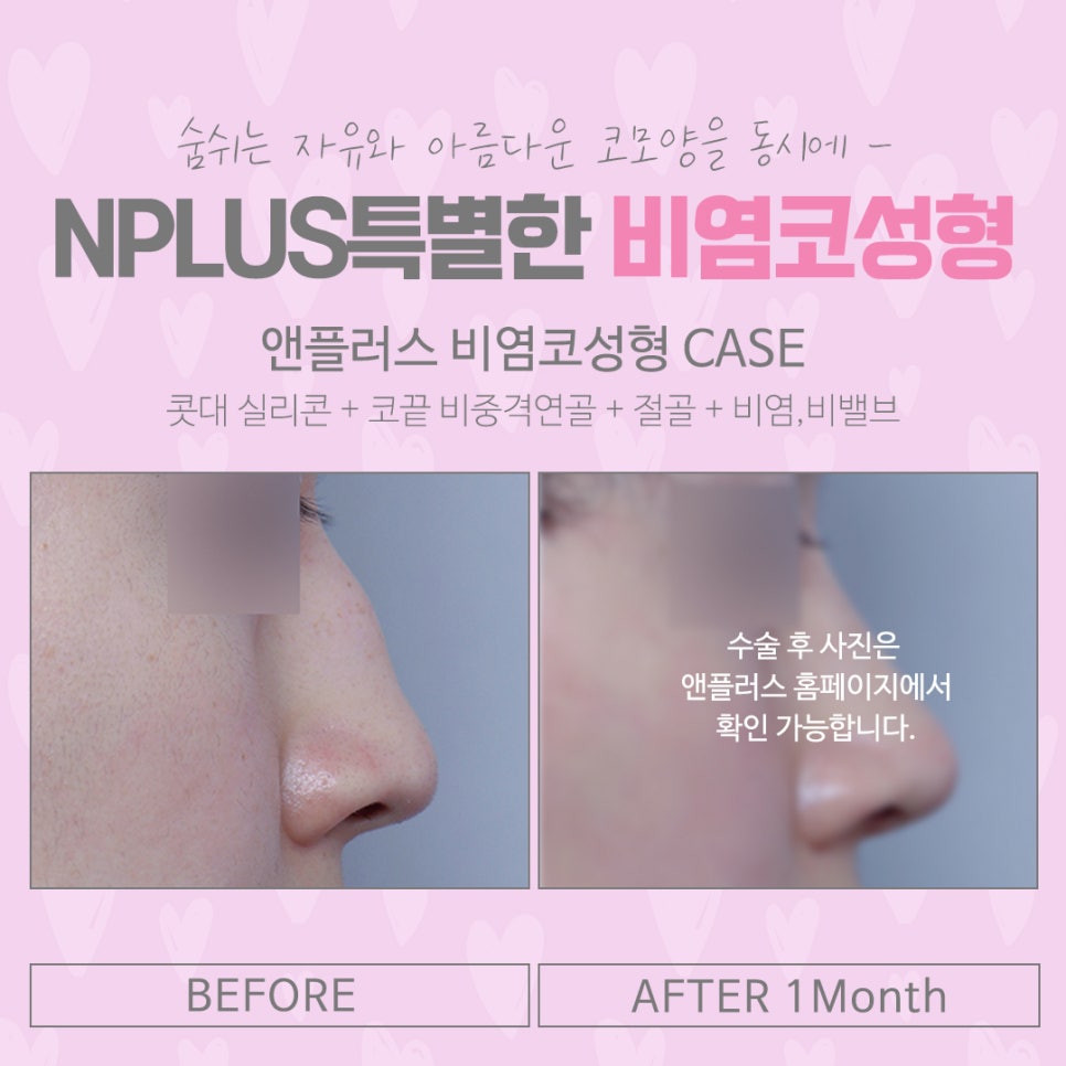 비염코수술 원인을 정확하게 파악하고 관련 이미지 14