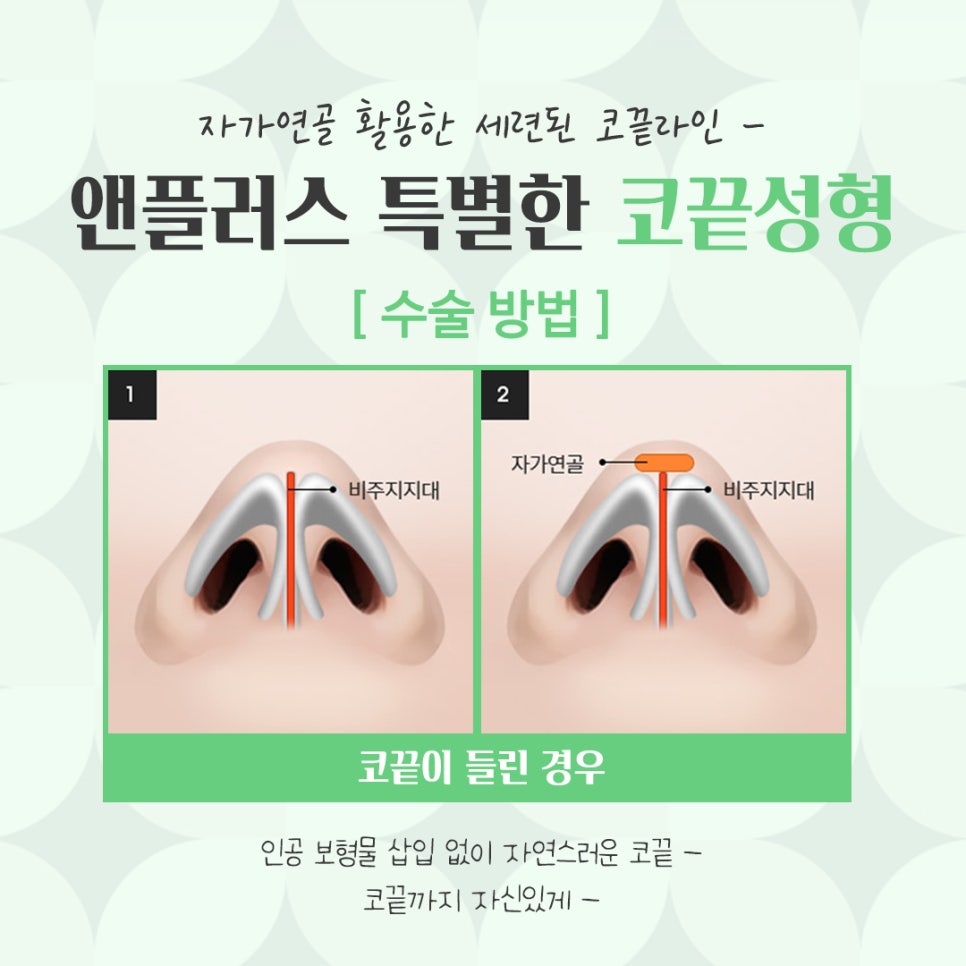 코끝수술후기 자가연골을 통해 자연스럽게 관련 이미지 7