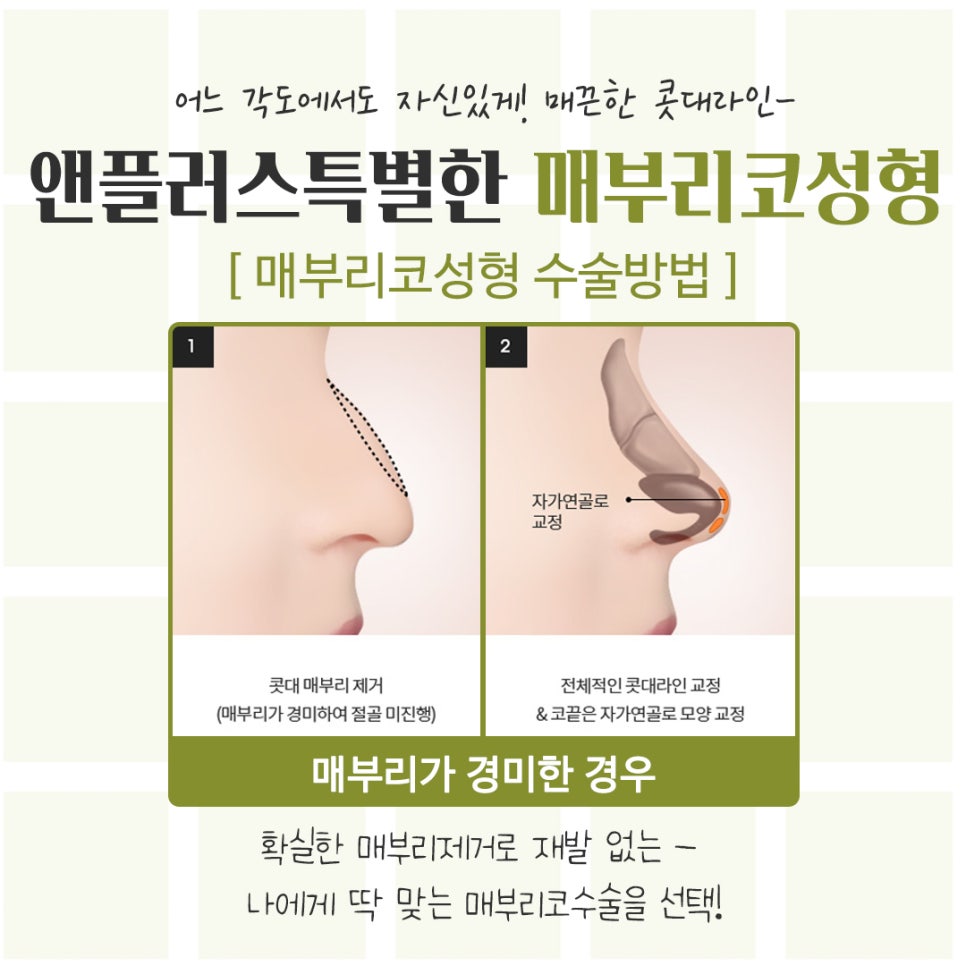매부리코성형후기 정확한 진단을 통해 관련 이미지 11