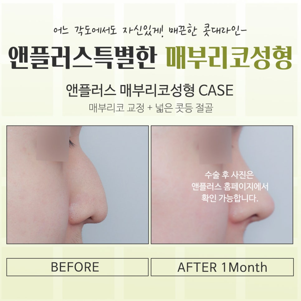 If You’re Looking for Reviews of Hump Nose Surgery image 15