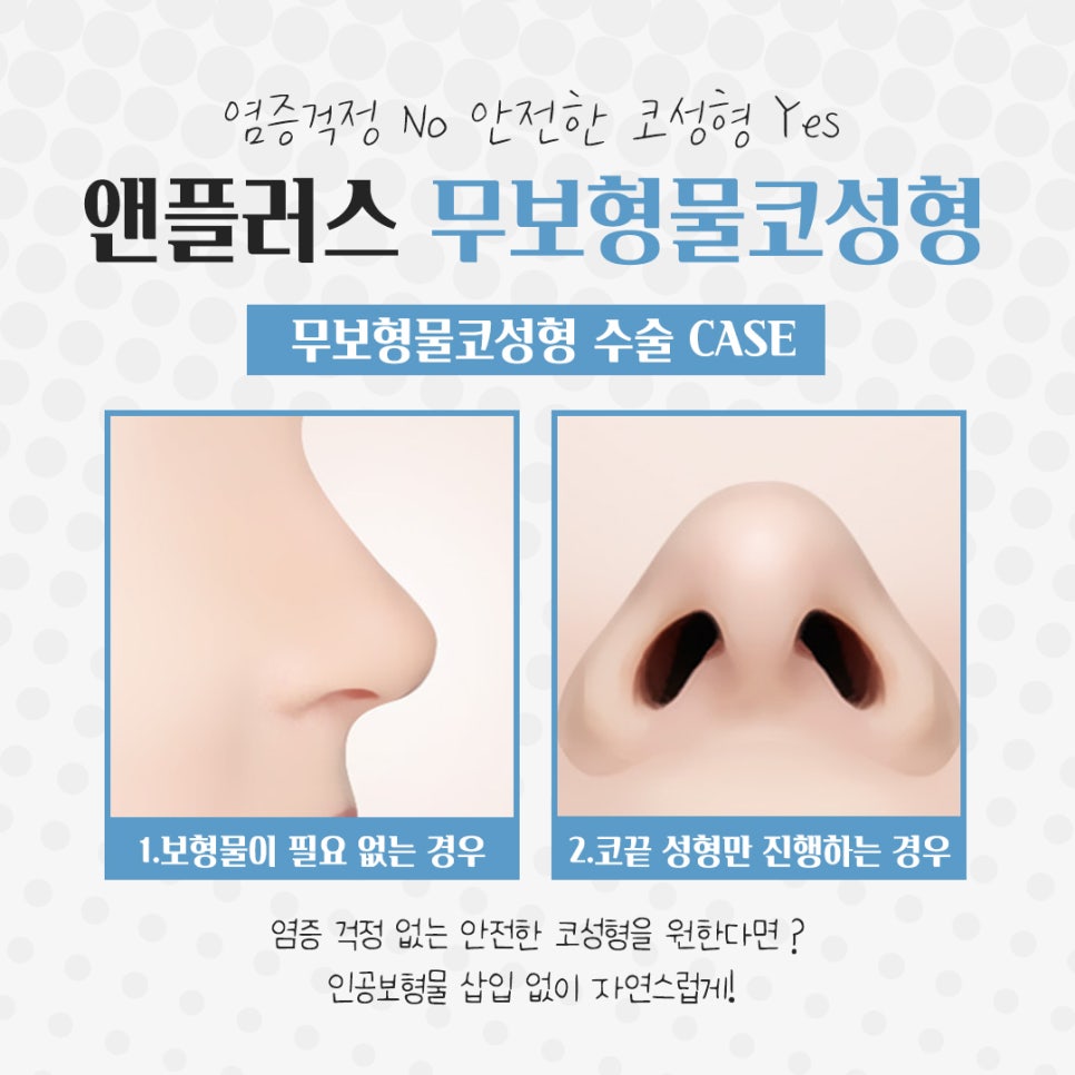 Non-Implant Rhinoplasty: Natural and Safe image 6