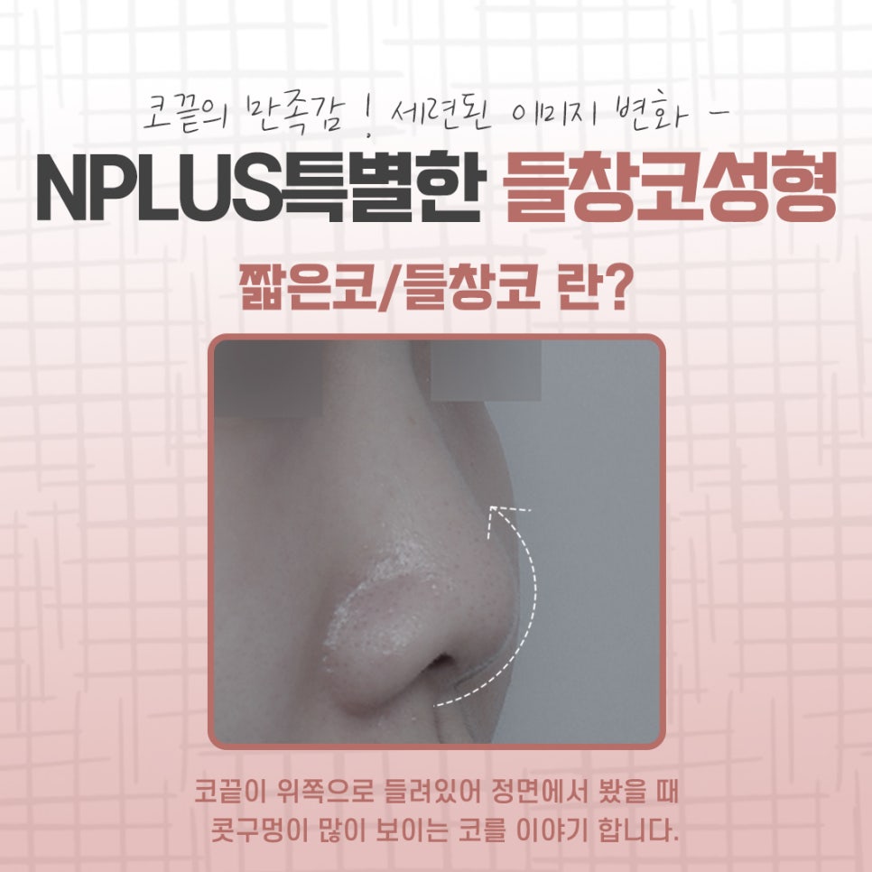 A Refined Look After Reviewing Upturned Nose Surgery Results image 4