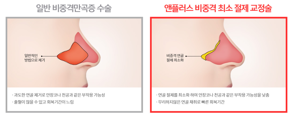 비염의 원인과 해결 방법! 관련 이미지 17