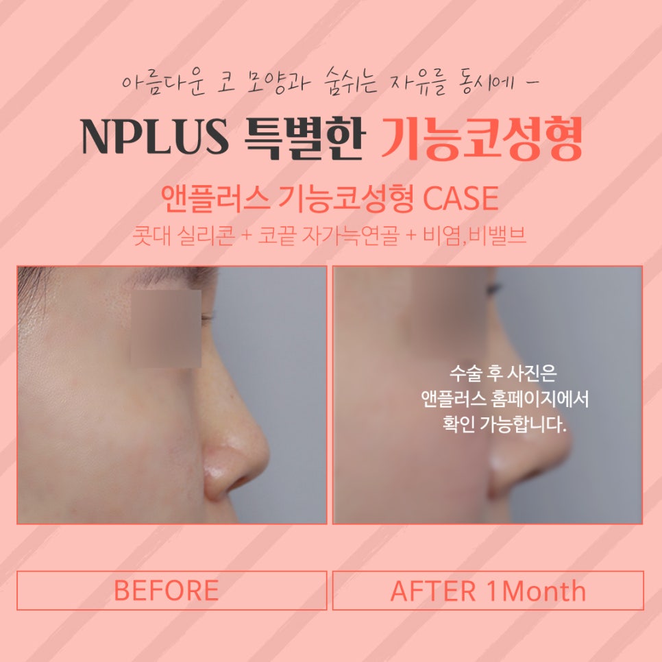 Female Rhinoplasty Review: A Line That Suits You image 12