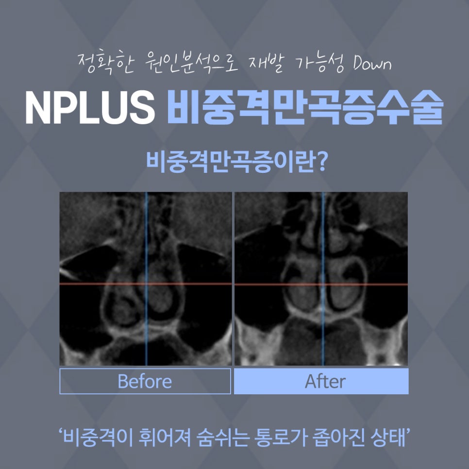 비중격코성형 정확한 원인 파악으로 관련 이미지 6