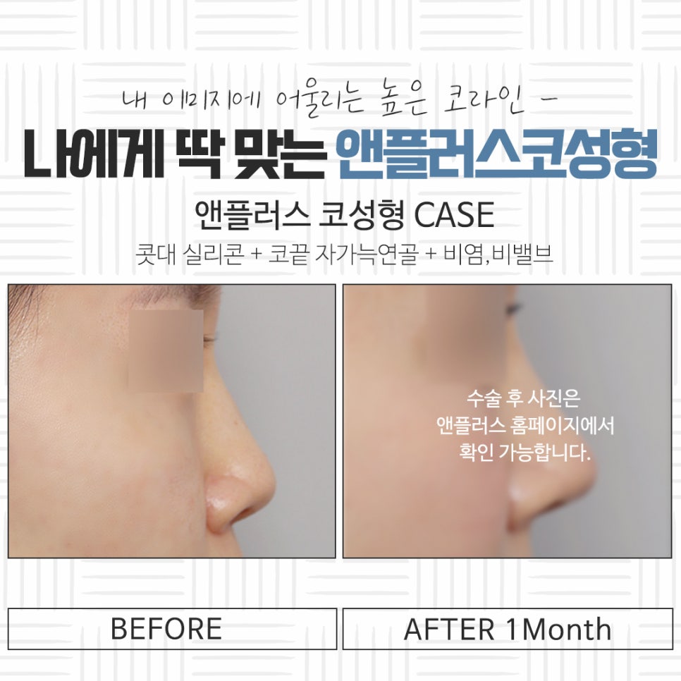 자가연골 이용한 코성형 후기 관련 이미지 16
