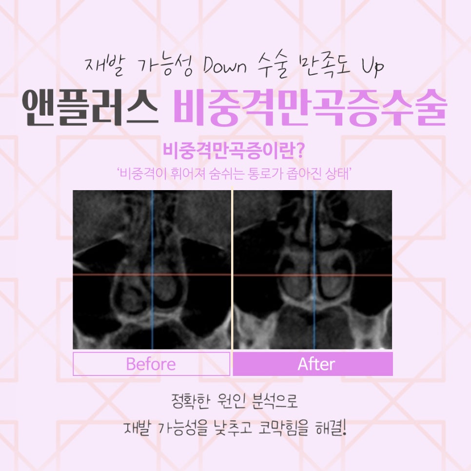 비중격만곡증수술후기 원인과 해결 방법까지 관련 이미지 4