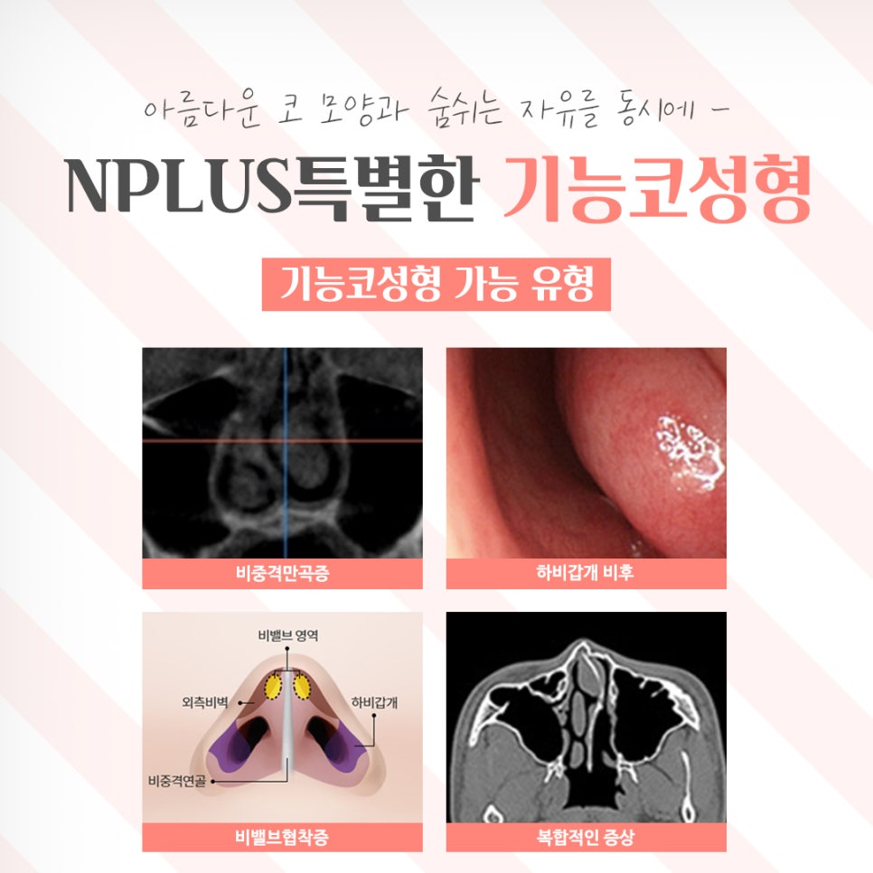 기능코성형후기 다양한 정보를 알아보고 관련 이미지 5