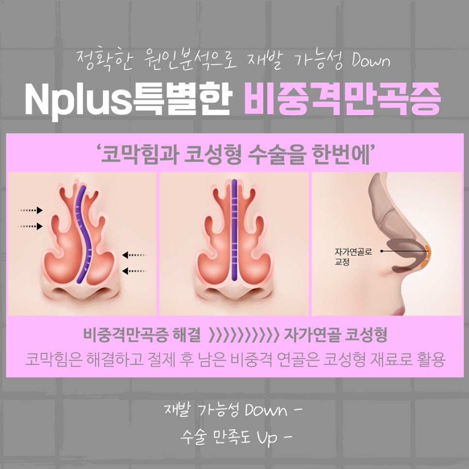 비중격만곡증수술 후기를 알아보고 결정 관련 이미지 11