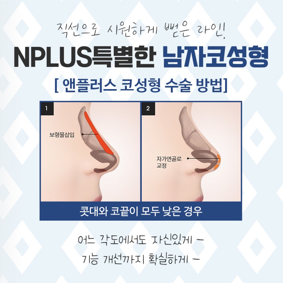 남자비염코성형 자세하게 알아보고 결정 관련 이미지 7